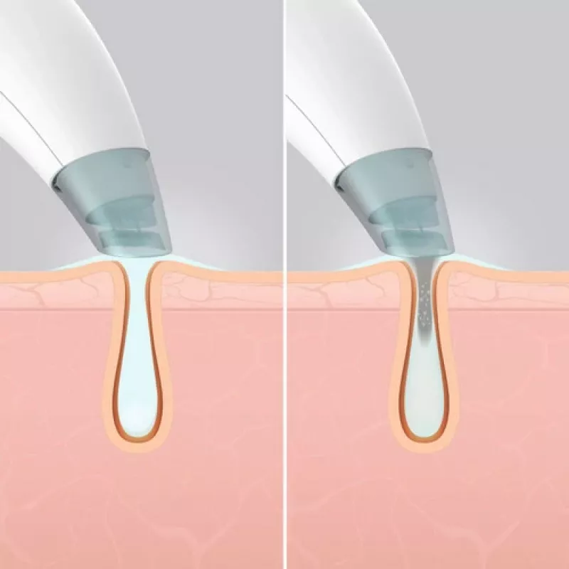 HoMedics FAC-HY100 hidradermabrazijos valiklis, skaidrus, baltas